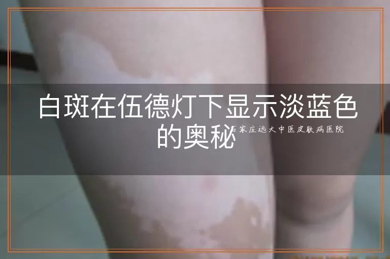 白斑在伍德灯下显示淡蓝色的奥秘
