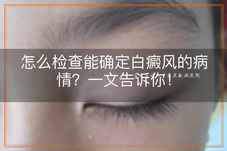 怎么检查能确定白癜风的病情？一文告诉你！