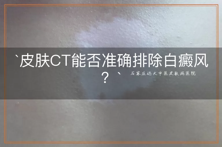 皮肤CT能否准确排除白癜风？