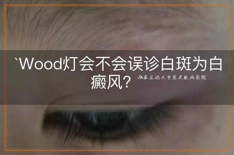 Wood灯会不会误诊白斑为白癜风？
