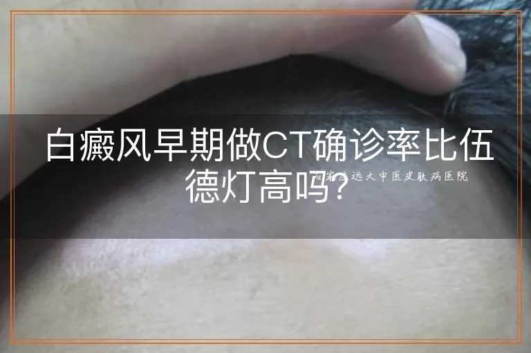 白癜风早期做CT确诊率比伍德灯高吗？