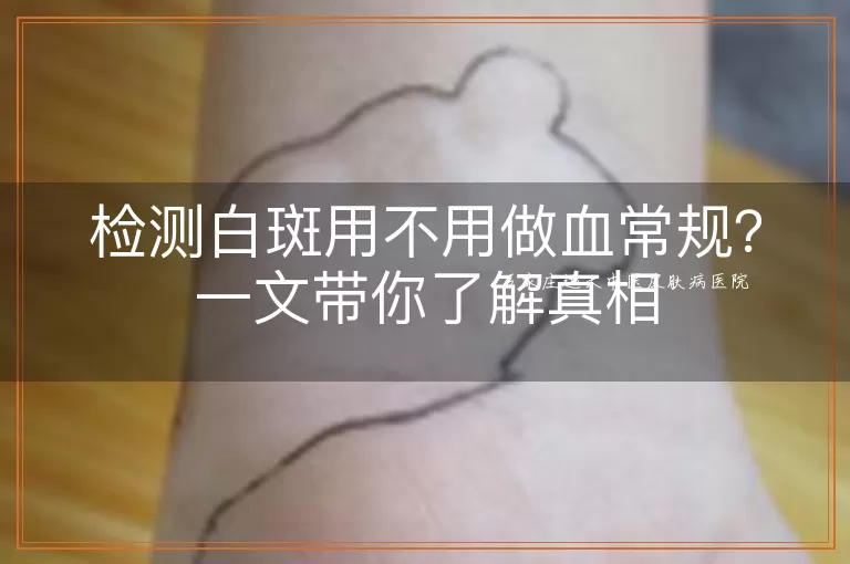 检测白斑用不用做血常规？一文带你了解真相