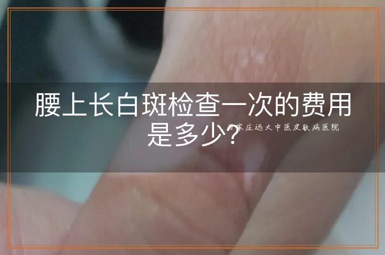 腰上长白斑检查一次的费用是多少？