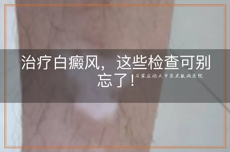 治疗白癜风，这些检查可别忘了！