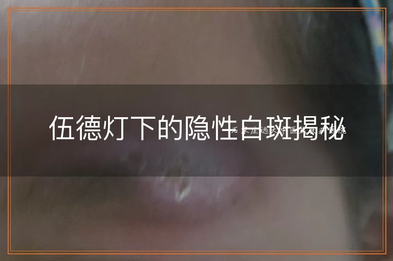 伍德灯下的隐性白斑揭秘