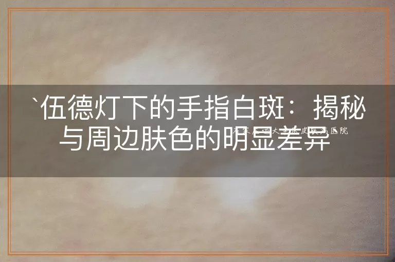 伍德灯下的手指白斑：揭秘与周边肤色的明显差异