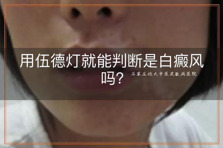 用伍德灯就能判断是白癜风吗？