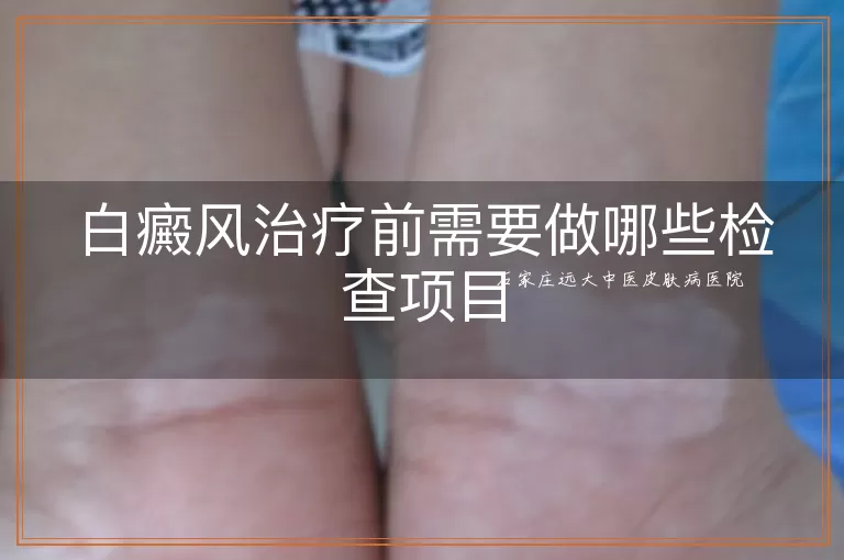 白癜风治疗前需要做哪些检查项目