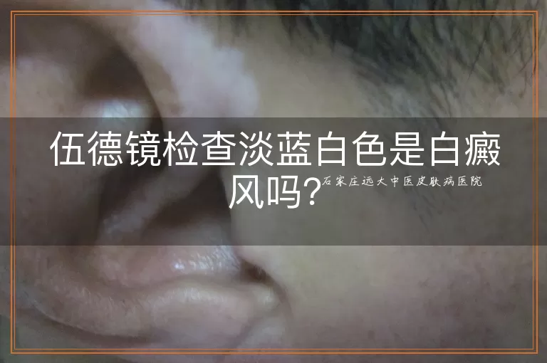 伍德镜检查淡蓝白色是白癜风吗？