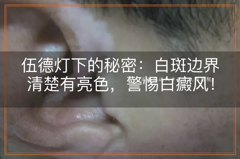 伍德灯下的秘密：白斑边界清楚有亮色，警惕白癜风！
