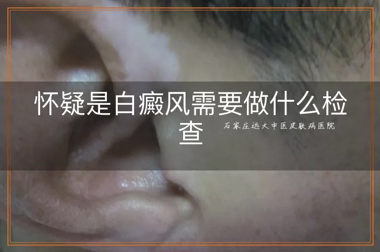 怀疑是白癜风需要做什么检查