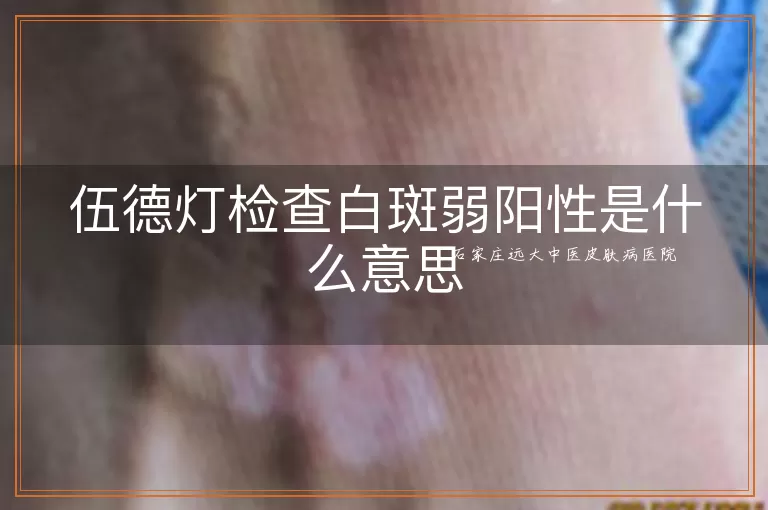 伍德灯检查白斑弱阳性是什么意思