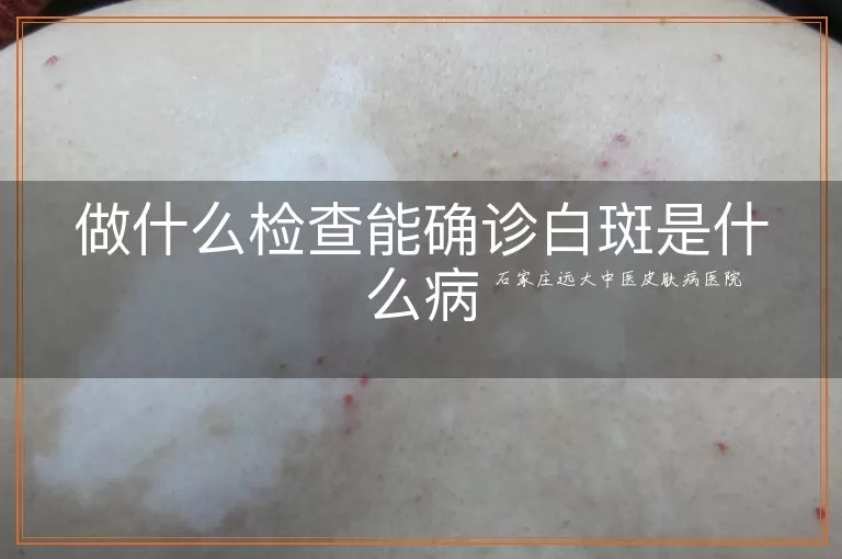 做什么检查能确诊白斑是什么病