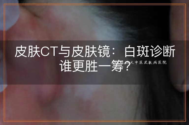 皮肤CT与皮肤镜：白斑诊断谁更胜一筹？