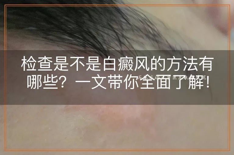 检查是不是白癜风的方法有哪些？一文带你全面了解！