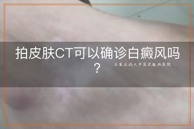 拍皮肤CT可以确诊白癜风吗？