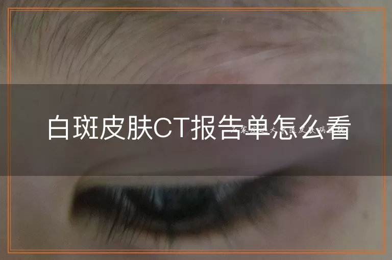 白斑皮肤CT报告单怎么看