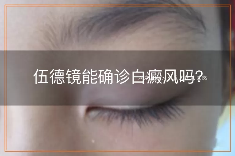 伍德镜能确诊白癜风吗？