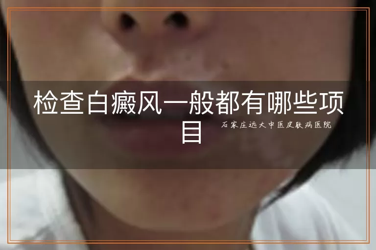 检查白癜风一般都有哪些项目