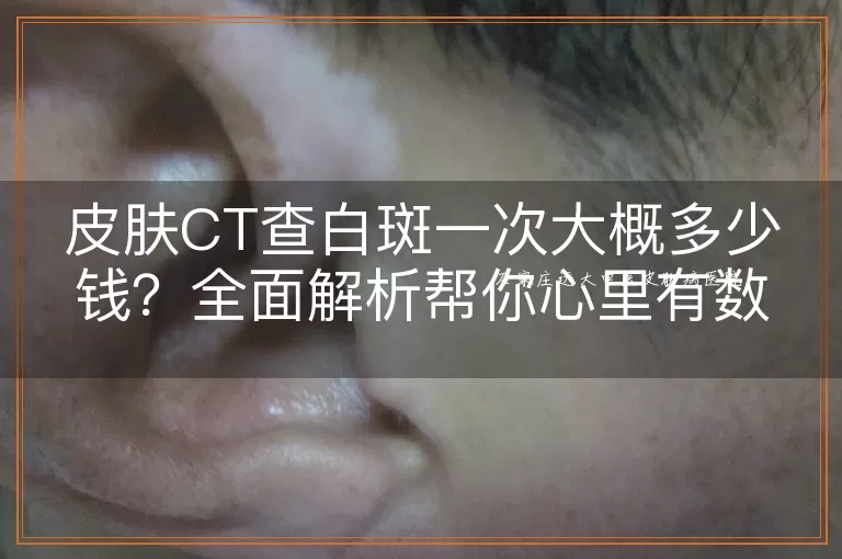 皮肤CT查白斑一次大概多少钱？全面解析帮你心里有数