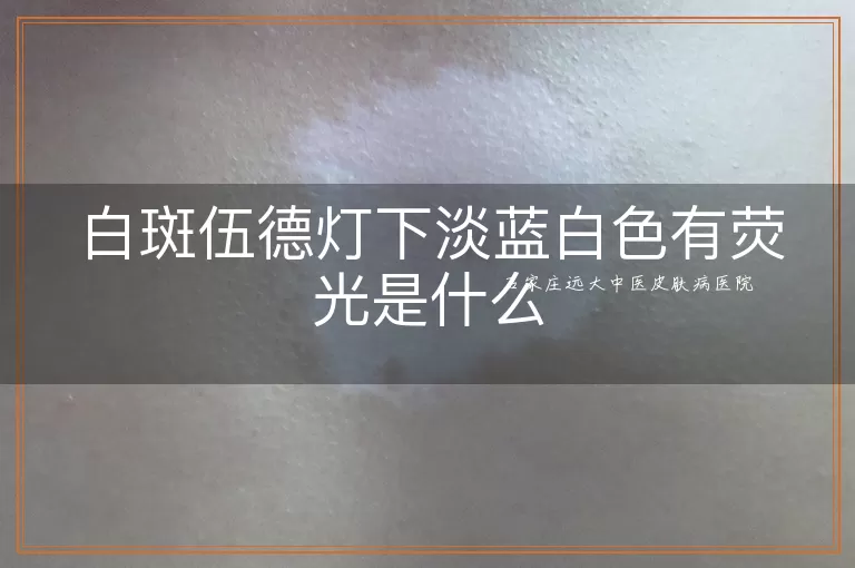 白斑伍德灯下淡蓝白色有荧光是什么