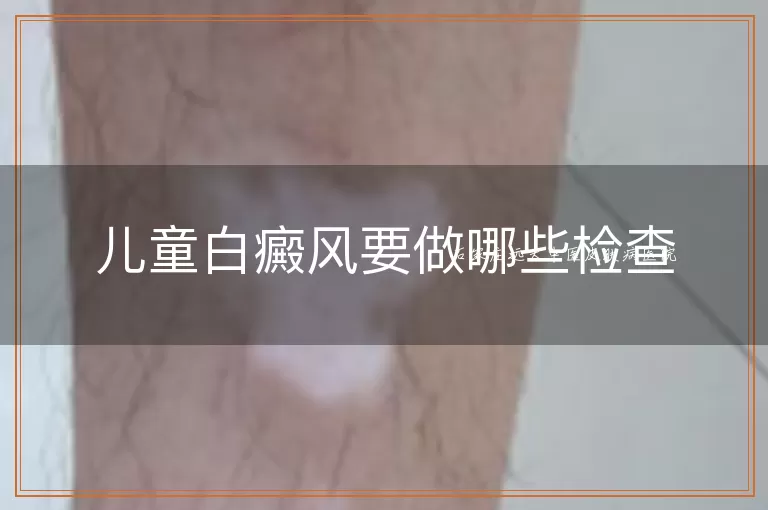 儿童白癜风要做哪些检查