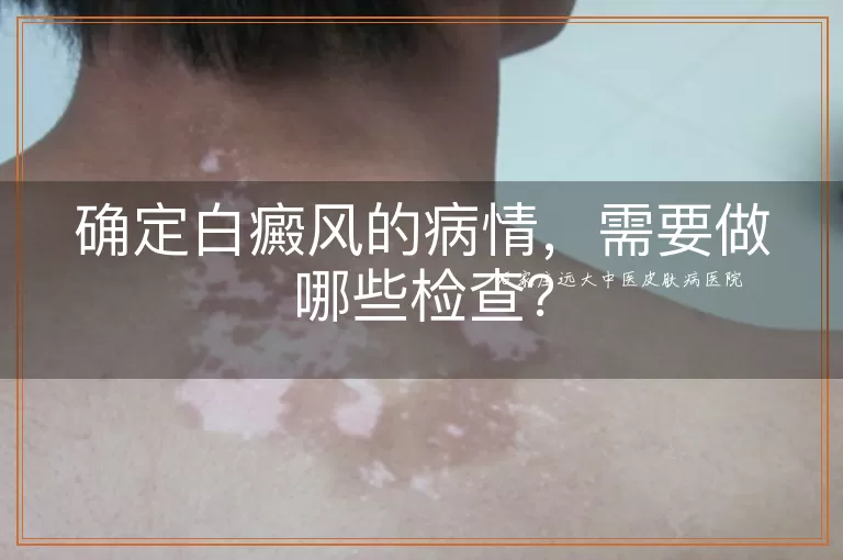 确定白癜风的病情，需要做哪些检查？