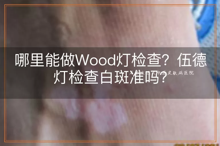 哪里能做Wood灯检查？伍德灯检查白斑准吗？