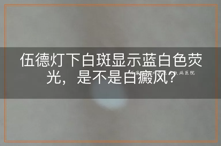 伍德灯下白斑显示蓝白色荧光，是不是白癜风？