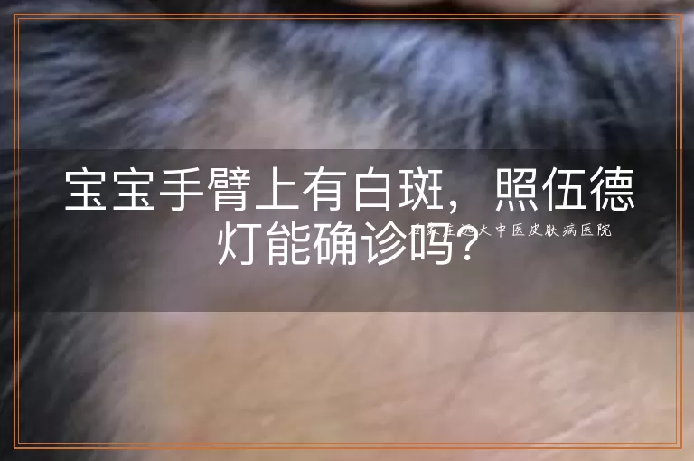 宝宝手臂上有白斑，照伍德灯能确诊吗？