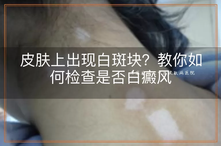 皮肤上出现白斑块？教你如何检查是否白癜风