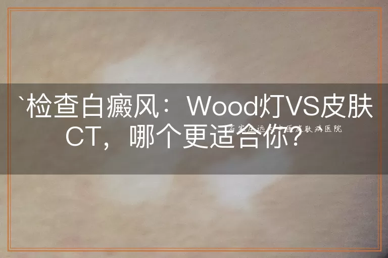 检查白癜风：Wood灯VS皮肤CT，哪个更适合你？