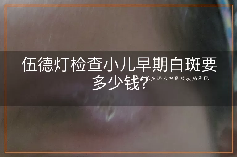 伍德灯检查小儿早期白斑要多少钱？