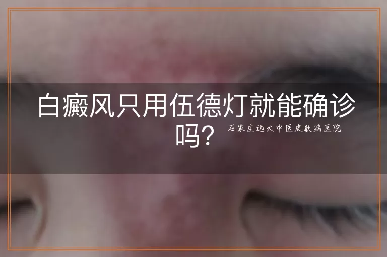 白癜风只用伍德灯就能确诊吗？