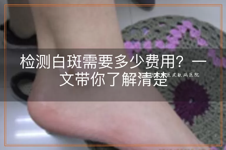 检测白斑需要多少费用？一文带你了解清楚