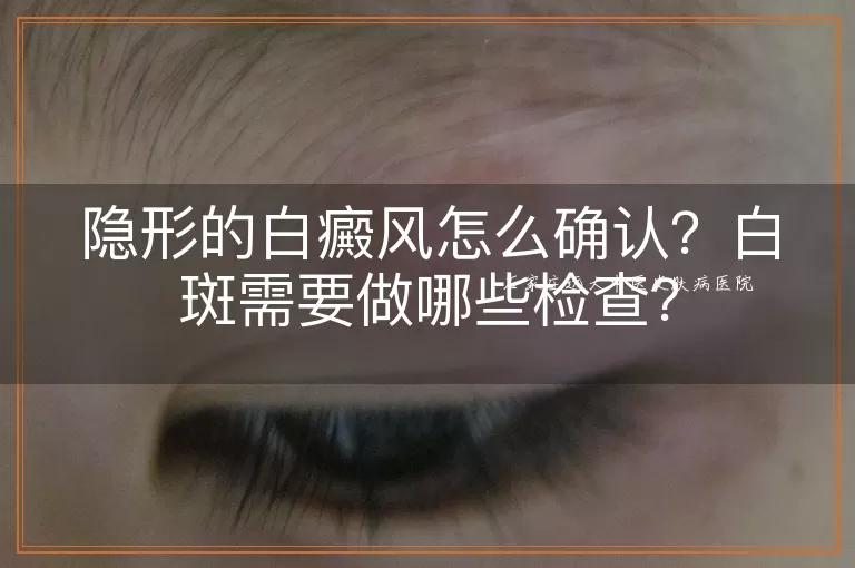 隐形的白癜风怎么确认?白斑需要做哪些检查?