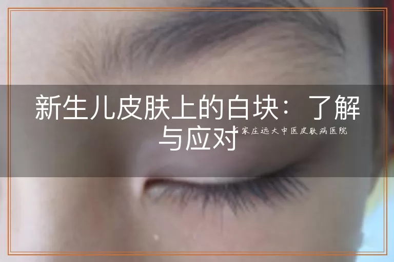 新生儿皮肤上的白块：了解与应对