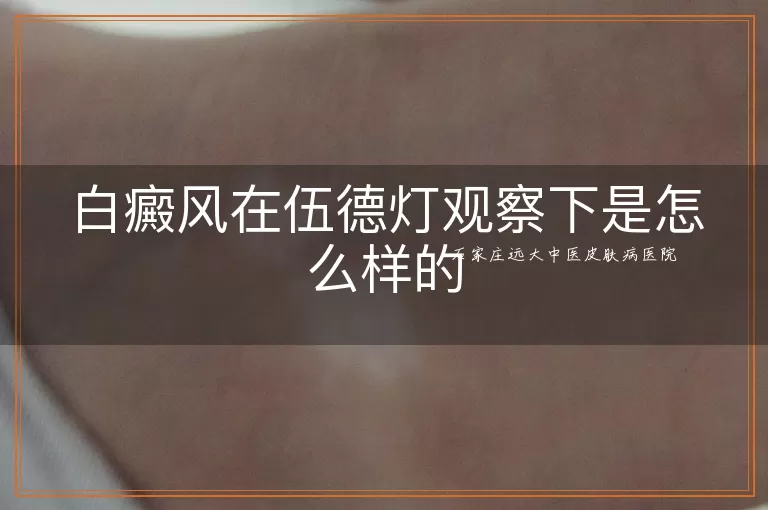 白癜风在伍德灯观察下是怎么样的