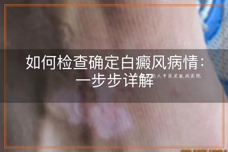 如何检查确定白癜风病情：一步步详解