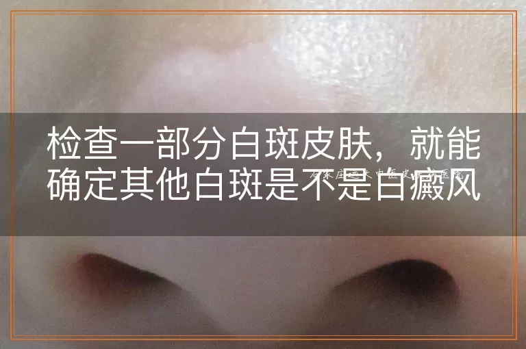 检查一部分白斑皮肤，就能确定其他白斑是不是白癜风吗？