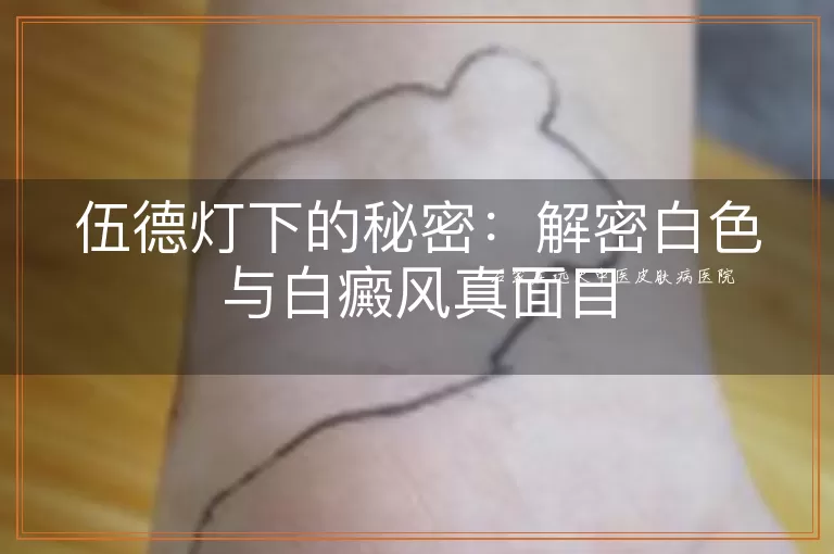 伍德灯下的秘密：解密白色与白癜风真面目