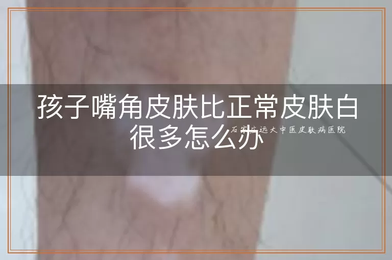 孩子嘴角皮肤比正常皮肤白很多怎么办