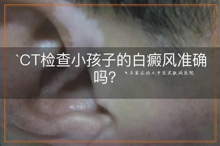 CT检查小孩子的白癜风准确吗？
