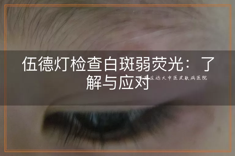 伍德灯检查白斑弱荧光：了解与应对