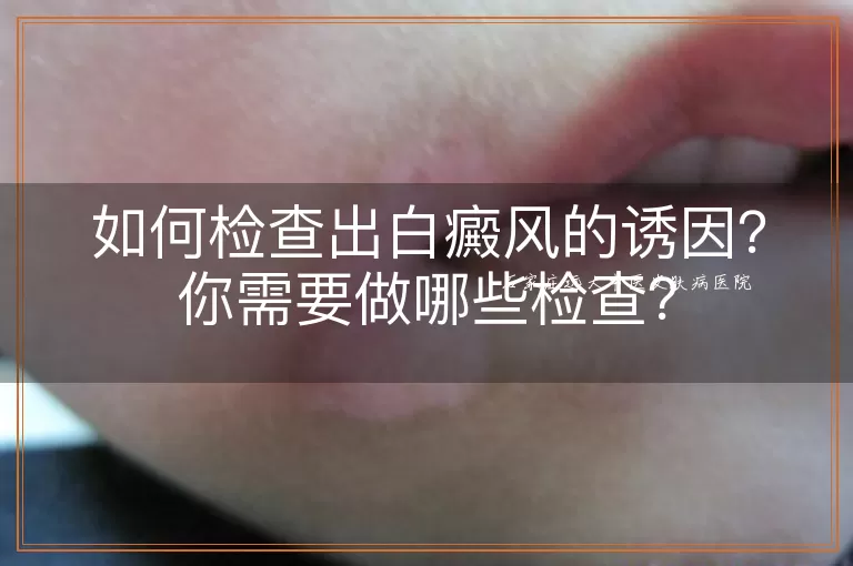 如何检查出白癜风的诱因?你需要做哪些检查?