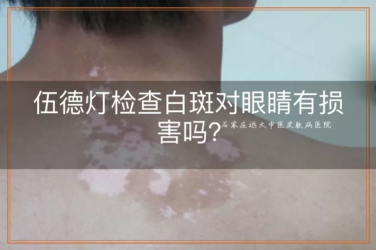 伍德灯检查白斑对眼睛有损害吗?