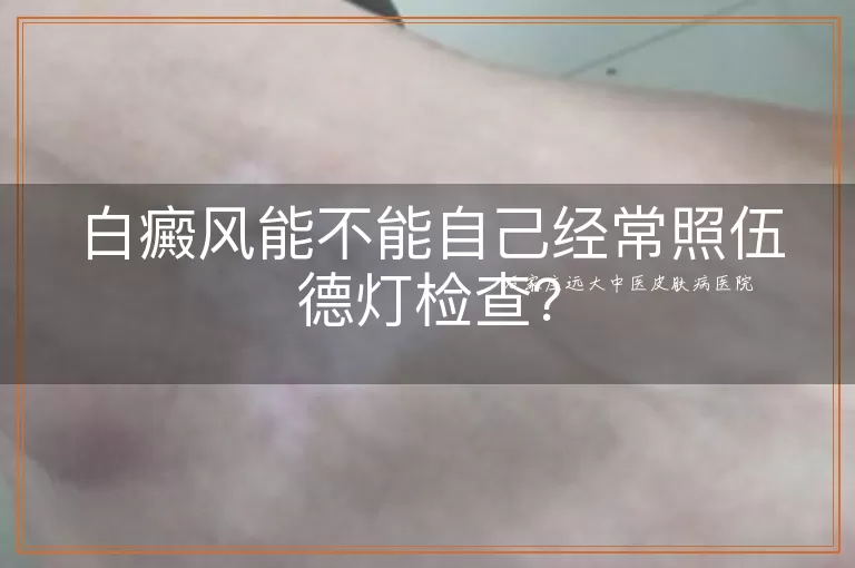 白癜风能不能自己经常照伍德灯检查？