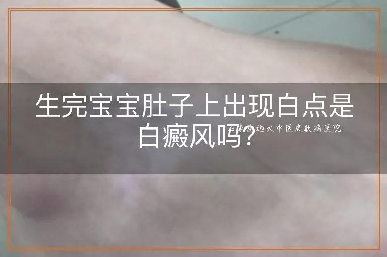 生完宝宝肚子上出现白点是白癜风吗？