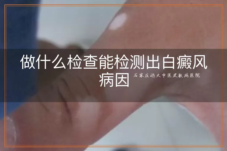 做什么检查能检测出白癜风病因