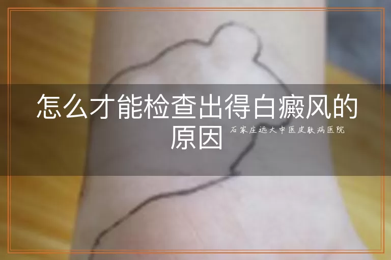 怎么才能检查出得白癜风的原因